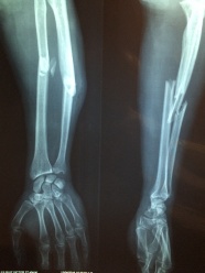 手骨骨折X光片图片